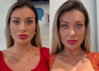 Andressa Urach expõe complicação após novo procedimento: ‘Arrependida’