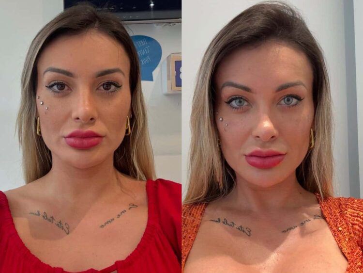 Andressa Urach expõe complicação após novo procedimento: ‘Arrependida’