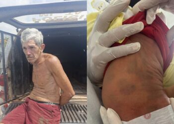 Equipe médica confunde mancha mongólica com hematomas e pai acaba preso por suspeita de espancar bebê