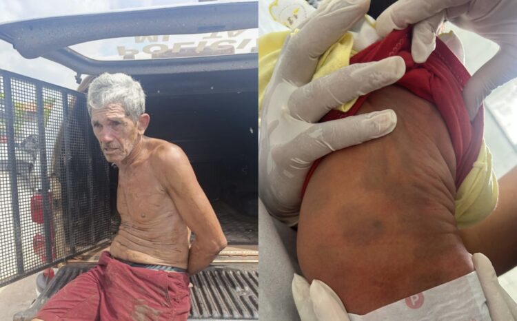 Equipe médica confunde mancha mongólica com hematomas e pai acaba preso por suspeita de espancar bebê