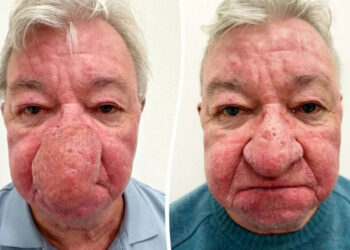 Escocês faz cirurgia para corrigir nariz gigante e poder voltar a beijar a esposa