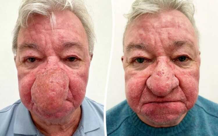 Escocês faz cirurgia para corrigir nariz gigante e poder voltar a beijar a esposa