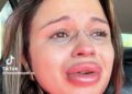 Arrependida, mulher chora após preenchimento labial e diz que procedimento “deveria ser proibido”