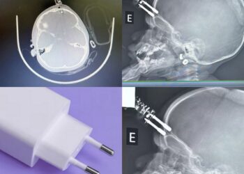 Menina de 1 ano fica com carregador cravado na testa após cair da cama em Divinópolis