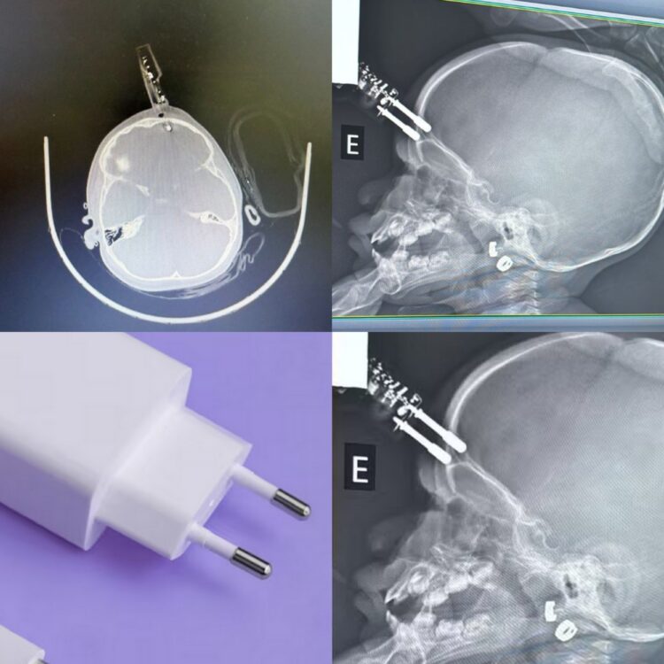 Menina de 1 ano fica com carregador cravado na testa após cair da cama em Divinópolis