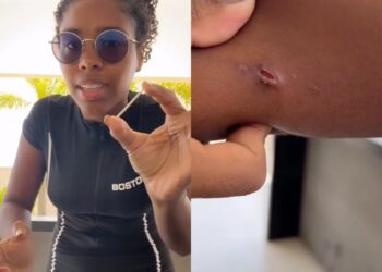 Vídeo mostra momento em que implante anticoncepcional sai do braço de mulher