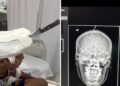 Jovem tem faca cravada na testa após briga entre irmãos, no interior do Pará