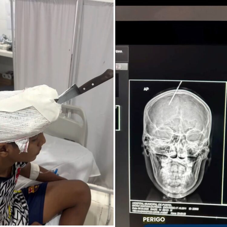 Jovem tem faca cravada na testa após briga entre irmãos, no interior do Pará
