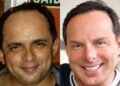 Marido de Gretchen, o paraense Esdhras de Souza, mostra antes e depois após plástica no rosto